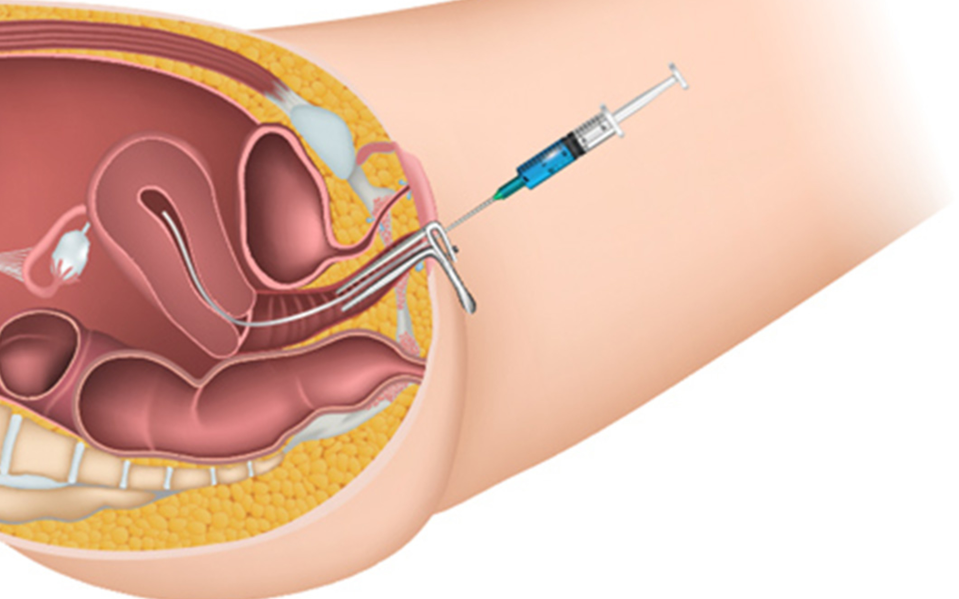 IUI Treatment in Mumbai
