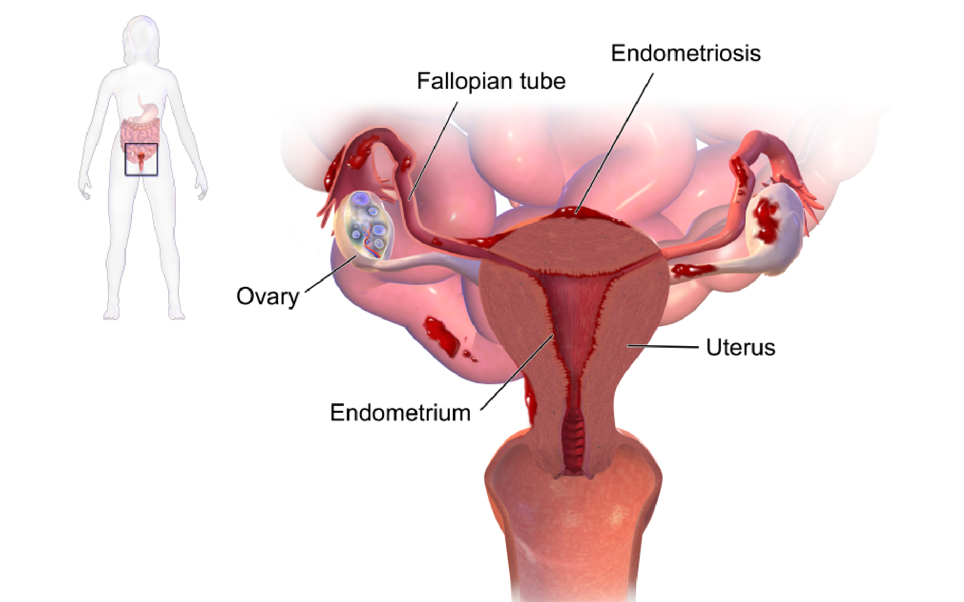 Endometriosis Treatment in Mumbai